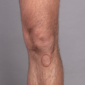 Tratamentul artrozei Dalian artroza genunchiului legată de vârstă